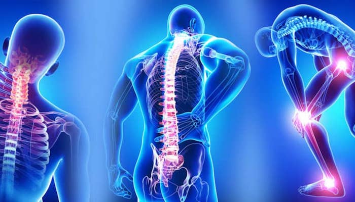 fibromyalgia